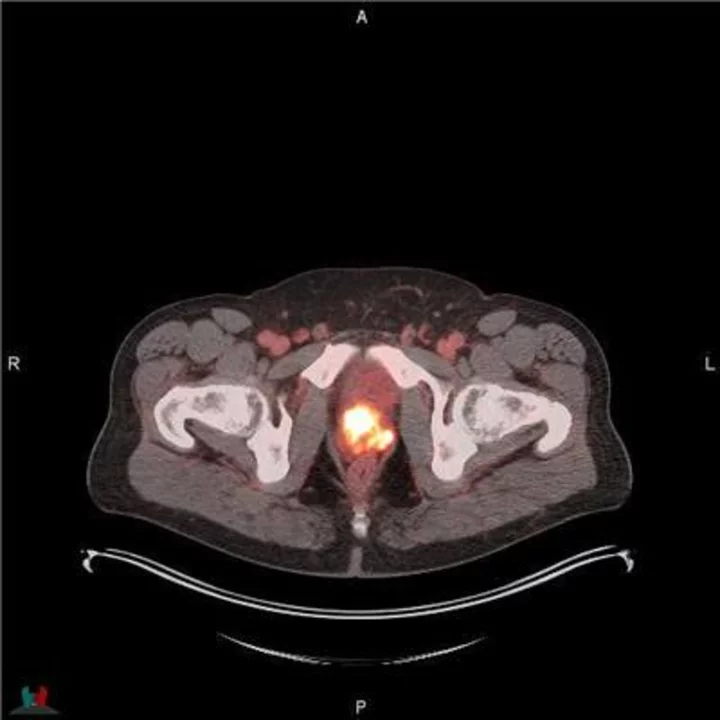 Additional Results of POSLUMA® (Flotufolastat F 18) Performance in Newly Diagnosed, High-risk Prostate Cancer Patients Presented at ASTRO